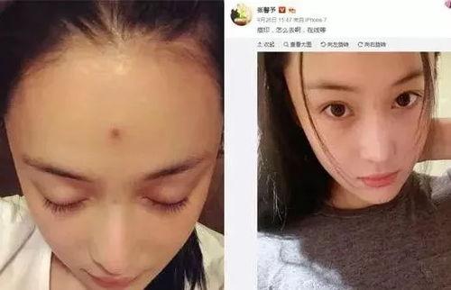长痘痘的明星,揭秘长痘明星的护肤秘籍与心路历程